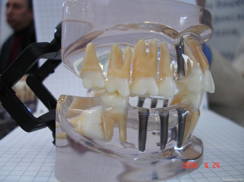 transparent  implantdisease model model/transparent jaw model with tee