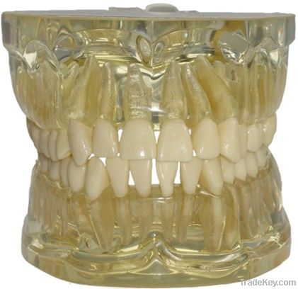 transparent tooth extraction model/transparent jaw model with teeth/Tr