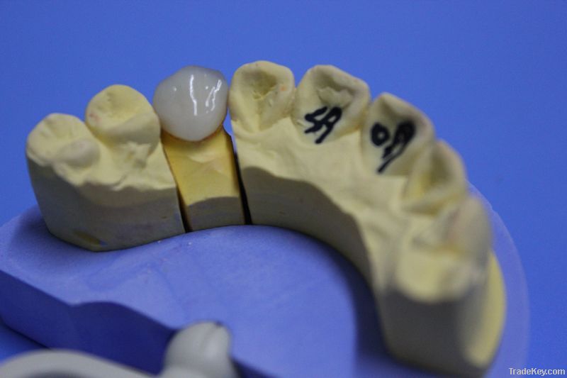 Dental Porcelain-Fused-To-Metal Crown