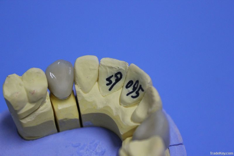 Dental Porcelain-Fused-To-Metal Crown