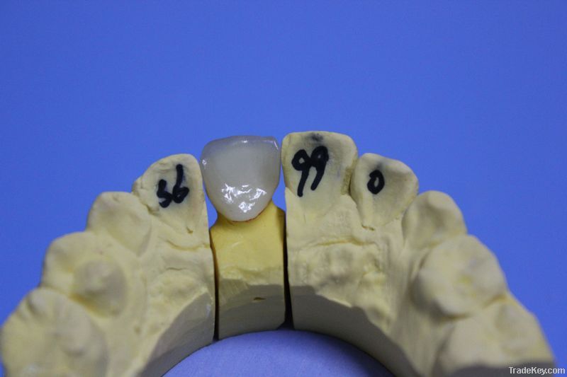 Dental Porcelain-Fused-To-Metal Crown