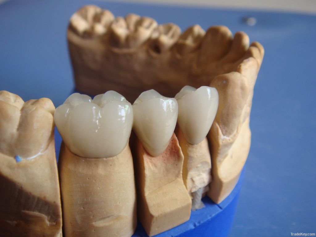 Dental porcelai fused to metal crown-