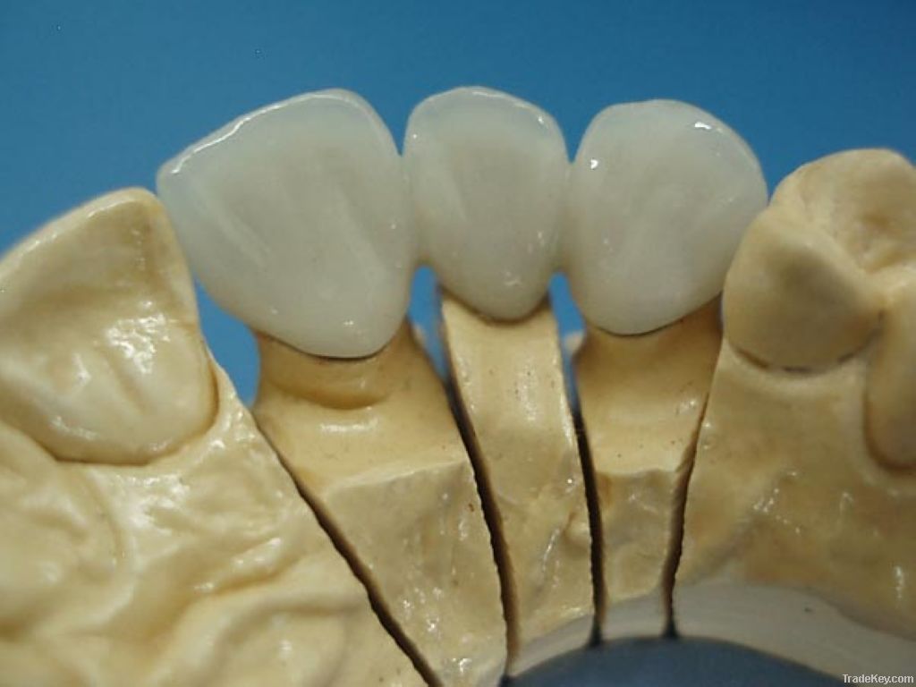 Dental E.max crown