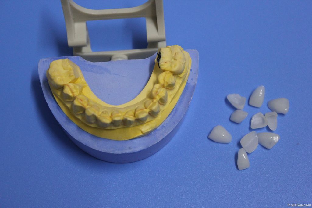 Dental E.max veneer