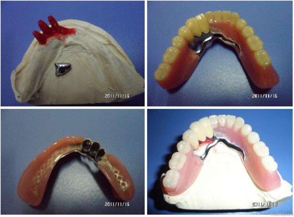 Dental telescope crown