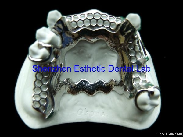 Dental Metal Partial Framework