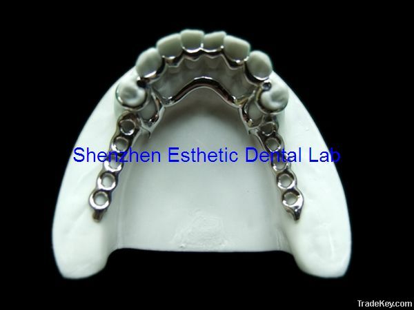 Dental metal partial framework