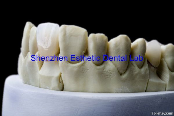 Dental Porcelain Fused-To-Metal Crown