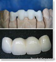 Dental zircon PFM porcelain crown supply
