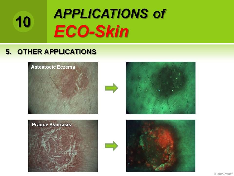 Skin Analyzer detecting Fluorescence