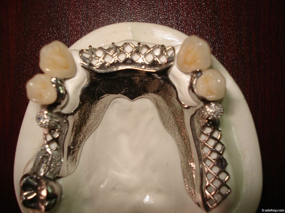 Cast partial framework denture