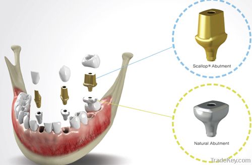 Natural and Scallop Abutment