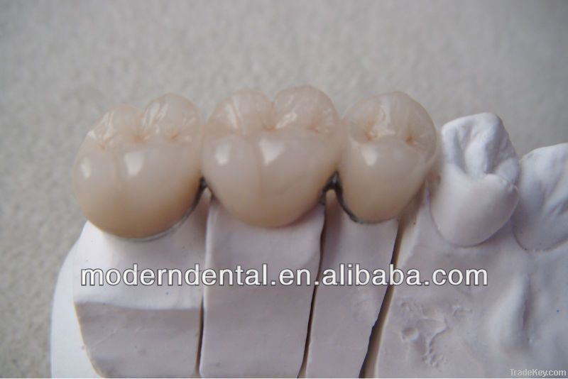 Dental PFM Porcelain Crown and Bridge supply
