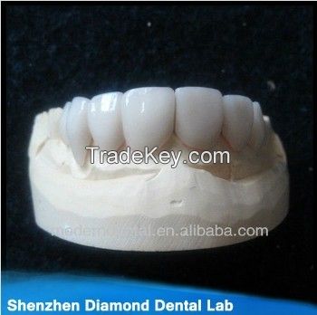Competitive price IPS E-max empress porcelain veneer dentals supplies 