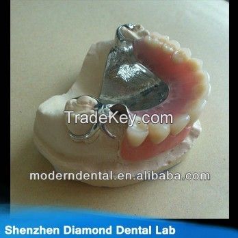 dental metal framework and casting partial denture