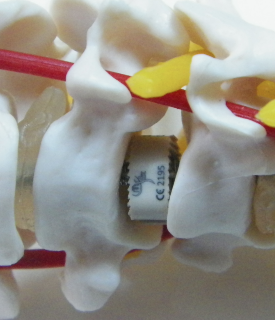 MSFX Spinal Implants