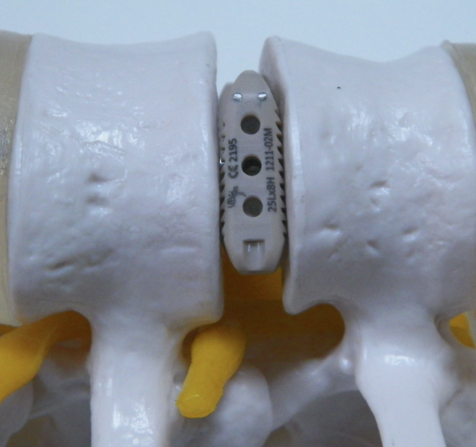 MSFX Spinal Implants