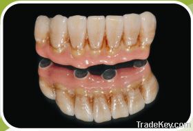 Implant Denture