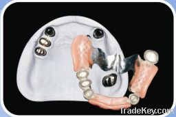 Telescopic Inner and Outer Crowns