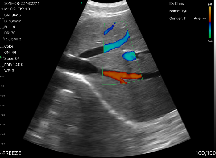 Wifi Probe Type 2 in 1 Double Head Probe Wireless Mini Color Doppler Ultrasound