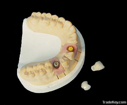 Dental Implant Prosthetics with Removable Teeth Restorations