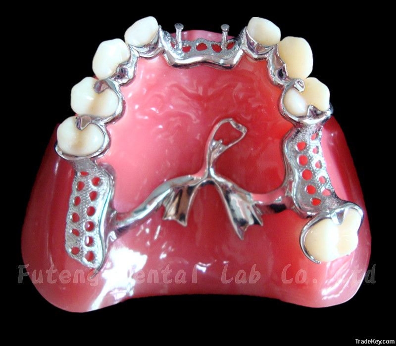 Sell Dental Removable Metal Framework and Casting Partial Denture(CCP)