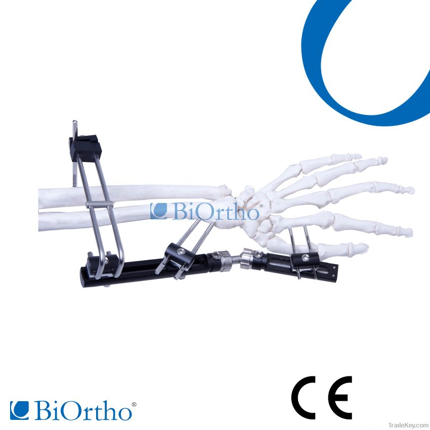 Distal Radious Fragment Orthofix External Fixator