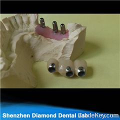 Dental Implant Crowns