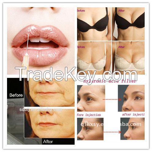 5ml/syring  cross linked hyaluronic acid dermal filler/ lip enhancer/ breast filler injection