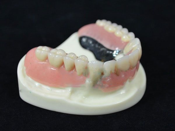 Removable Denture (Telescopic Crowns and Dentures)