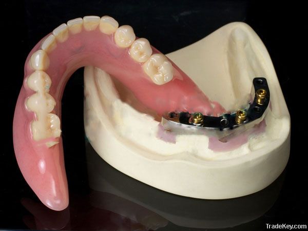 Denture (Implant Bar Overdenture)