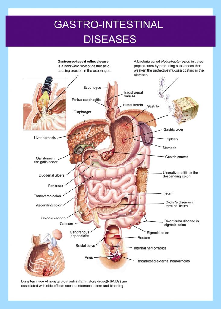 3D Medical Chart--Gastro-intestinal Disease
