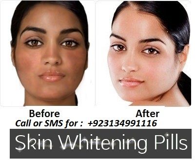 glutathione underarm whitening cream/skin whitening pills/teeth whitening light in Quetta--03117050633