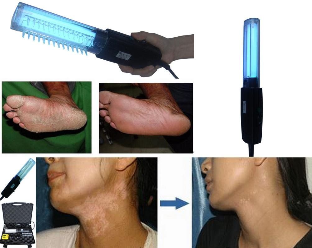 Ultraviolet Light Treatment Psoriasis, Vitiligo, Eczema, Phototherapy