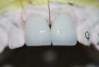 false teeth/dental teeth/pfm crown