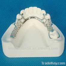 framework/metal denture
