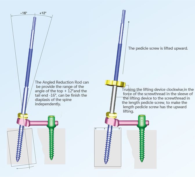 KSS-III 6.0 Spinal System(Slipping)    