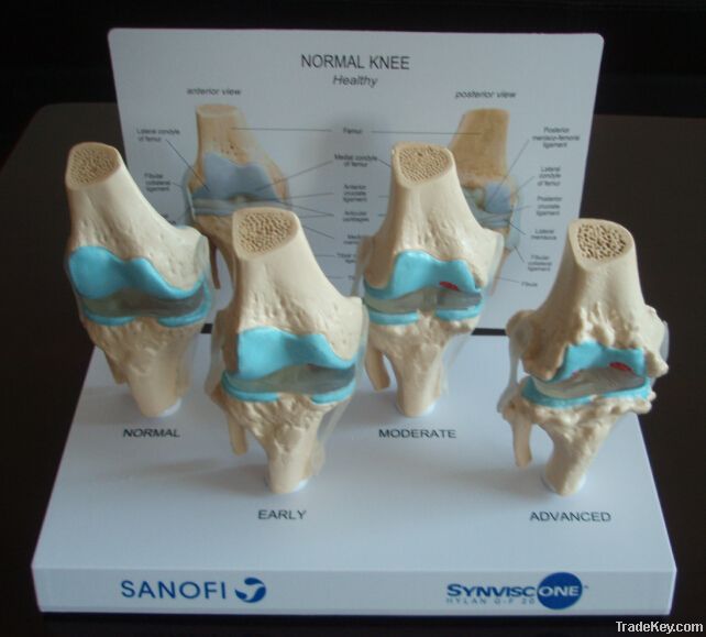 SE34072 Four Stages of Osteoarthritis Anatomical Model