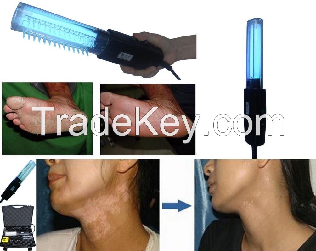 Narrow band uvb lamp for vitiligo, psoriasis, eczema, skin disease