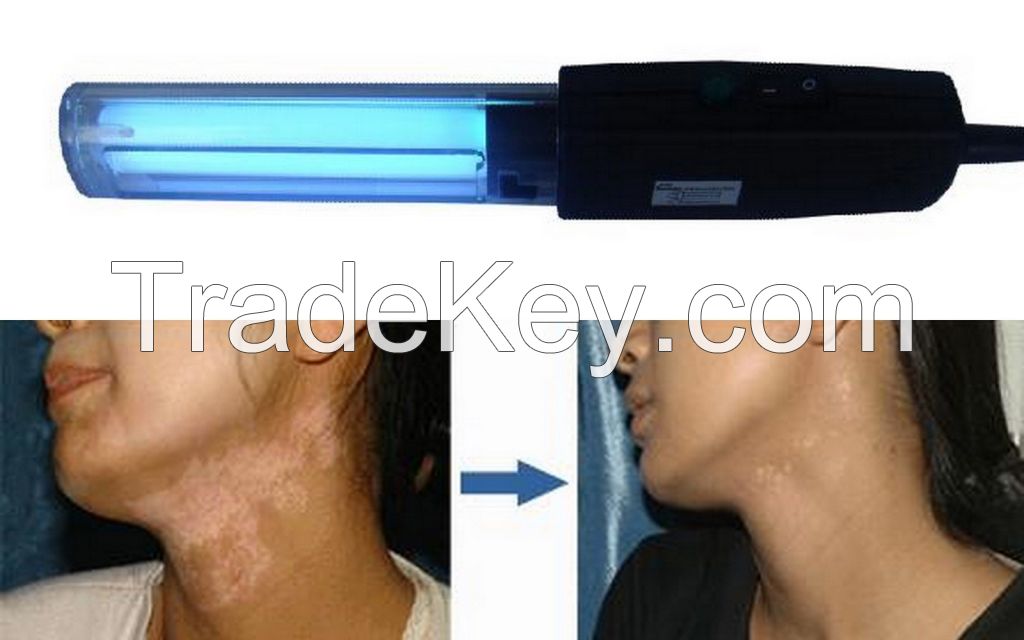 Narrow band uvb lamp for vitiligo, psoriasis, eczema, skin disease