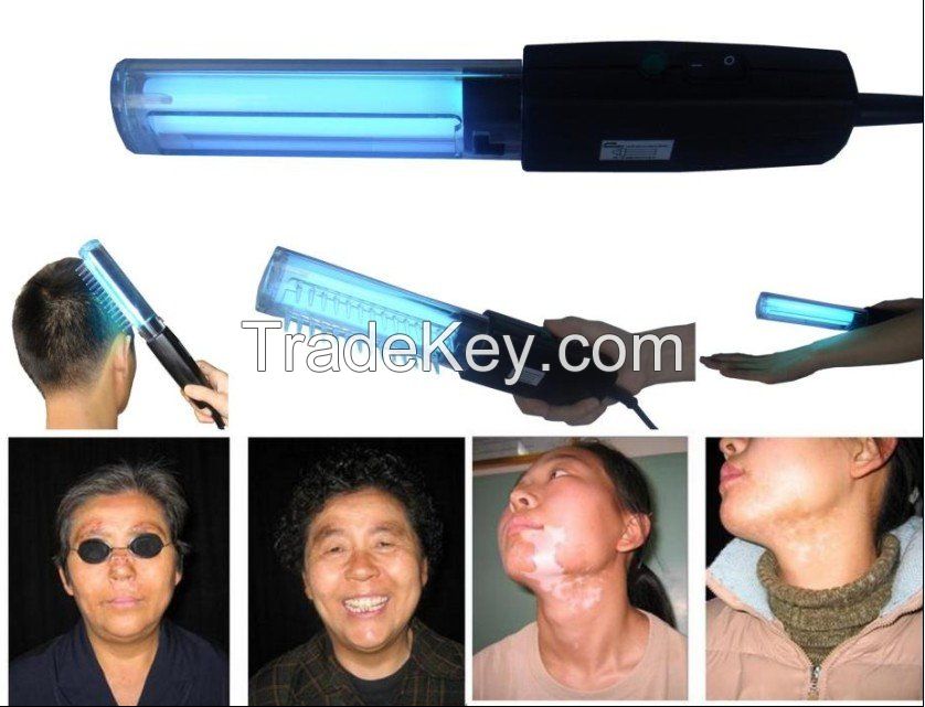 311nm uvb lamp for vitiligo, psoriasis, eczema and other skin disease