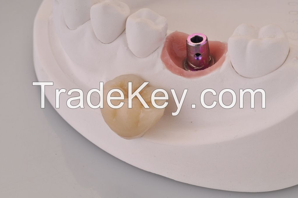 Implant PFM crown