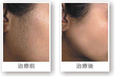 Very good effect SHR ipl hair removal laser CE approved