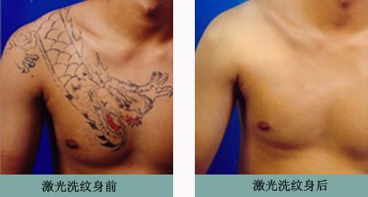 Nd yag laser tattoo removal+CE+1064nm,532nm