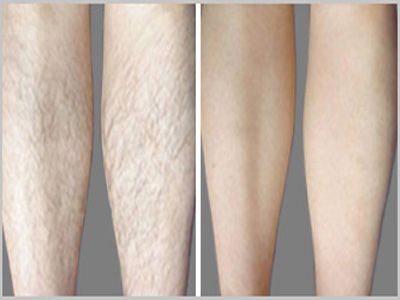 Effective diode laser hair removal+808nm laser+CE approved+2014 