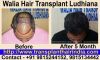 Walia Hair Transplant India Affordable Cost 