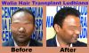 Walia Hair Transplant India Affordable Cost 