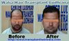 Walia Hair Transplant India Affordable Cost 