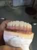 Implant denture dental restorations dental supplies