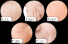 SkinSpotCream (for acne, wrinkle, mark)